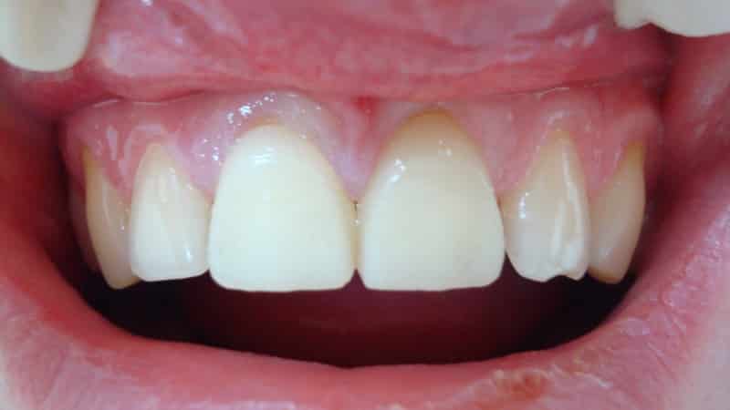 какие зубы лучше вставить пластмассовые или керамические