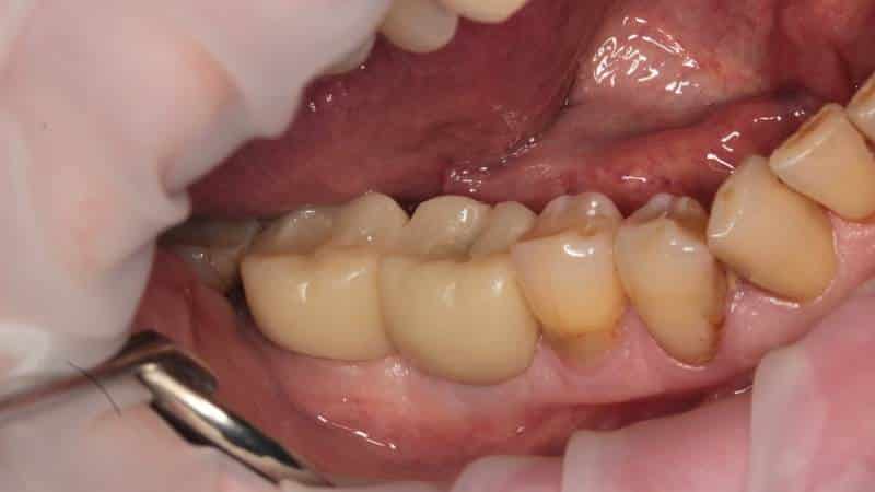 пластмассовые коронки на жевательные зубы