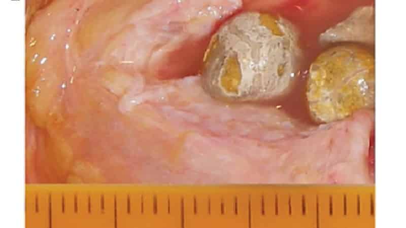 Камень в слюнной железе: симптомы и лечение слюннокаменной болезни