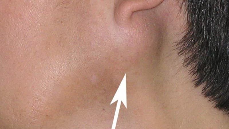 камни в слюнной железе лечение симптомы