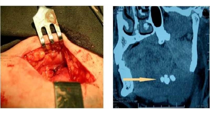 слюннокаменная болезнь симптомы лечение народными средствами