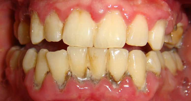 Камни на зубах Камни на зубах