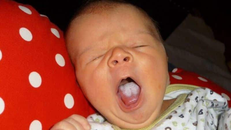 кандид стоматит