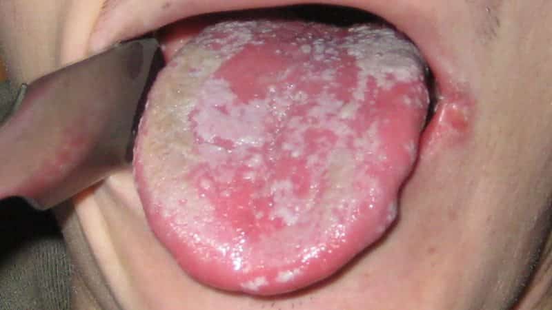 кандидоз на языке фото