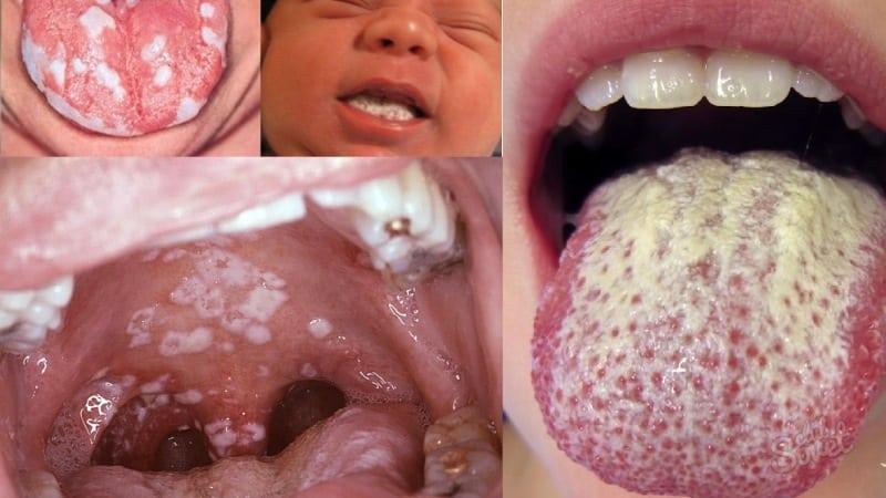 кандидоз языка симптомы