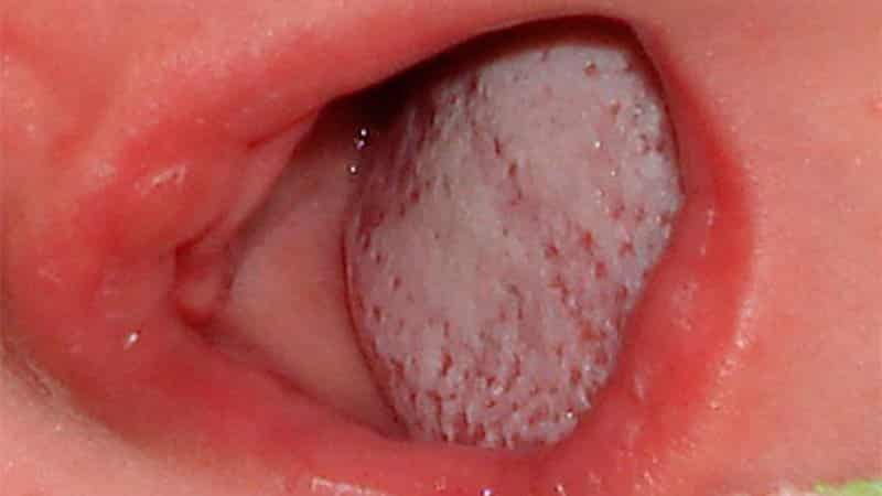 кандидозный стоматит у детей фото