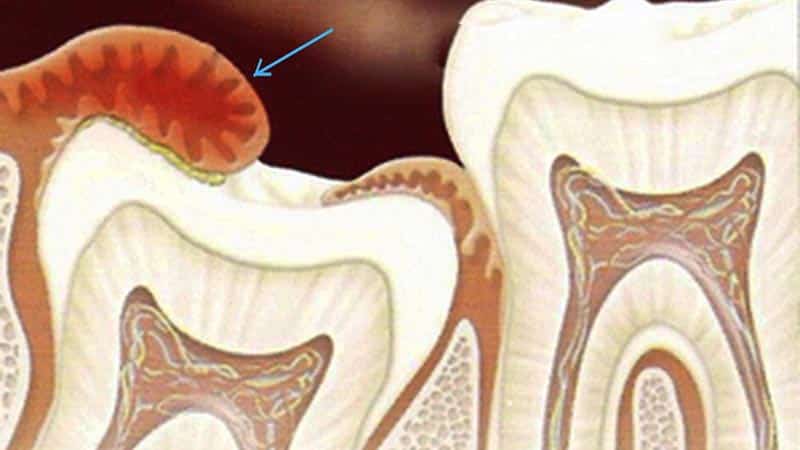 Причины удаления капюшона зуба мудрости