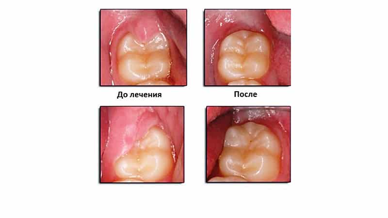 Удаление капюшона над зубом мудрости