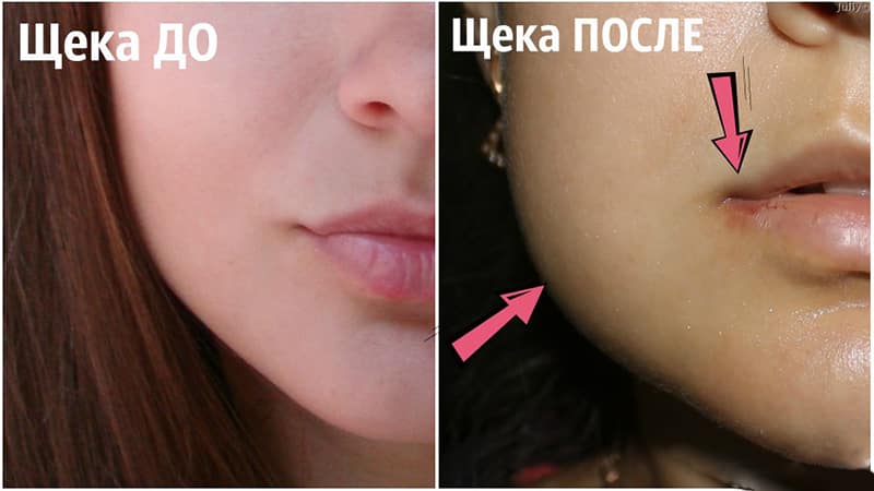 Симптомы появления воспаления капюшона зуба мудрости