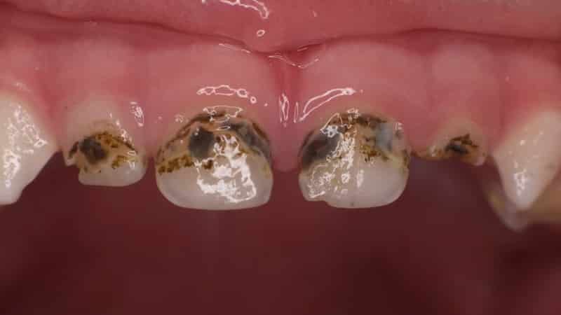 лечение передних зубов до и после