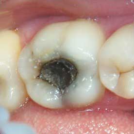 Кариес Кариес