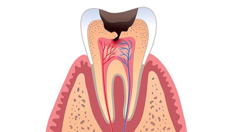 как лечить кариес зубов