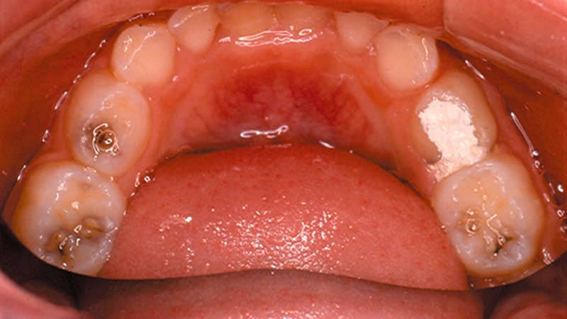 лечение кариеса в домашних условиях народными средствами