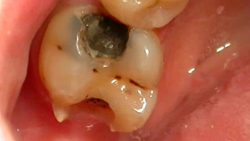 как бороться с кариесом