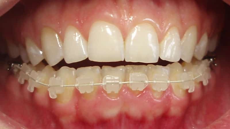 керамические брекеты фото до и после