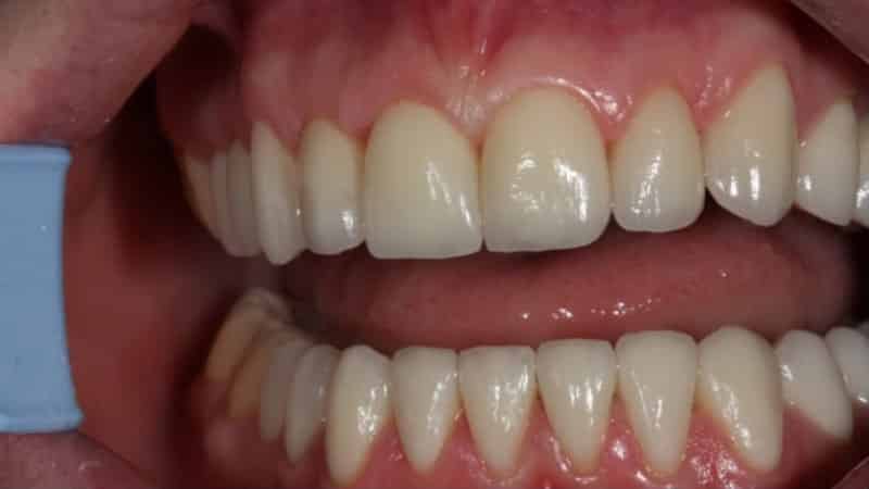 керамическая коронка на зуб фото