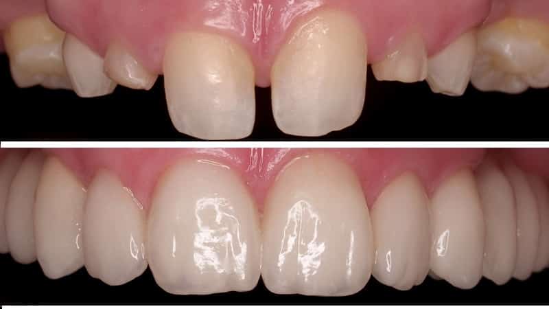 керамическая коронка на зуб отзывы