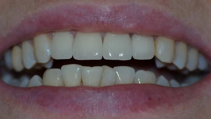 керамические зубы фото
