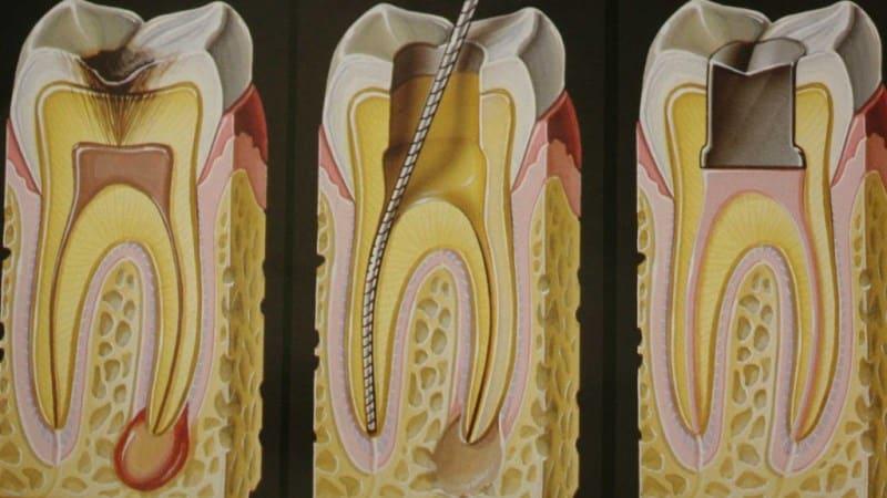 коды мкб хронический фиброзный пульпит