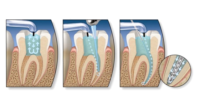 жалобы хронический фиброзный пульпит