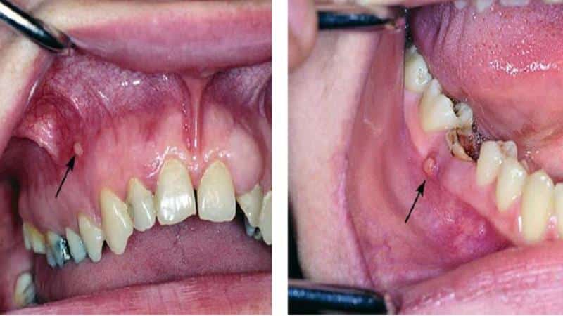 хронический фиброзный периодонтит