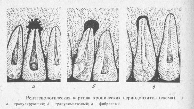 хронический периодонтит фото
