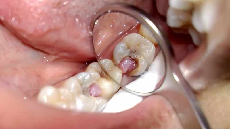 хронический пульпит что это такое