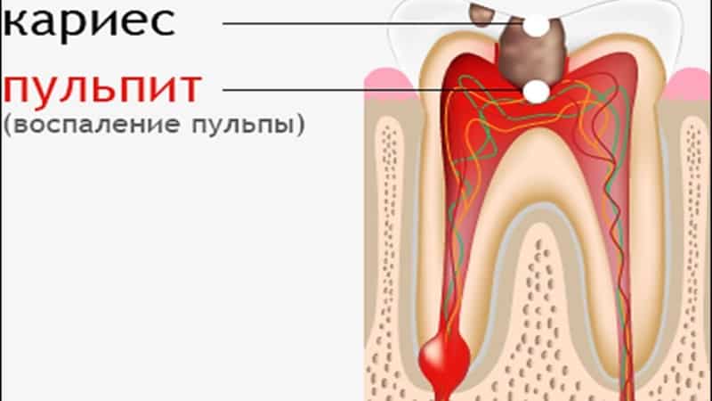 хронический гипертрофический пульпит
