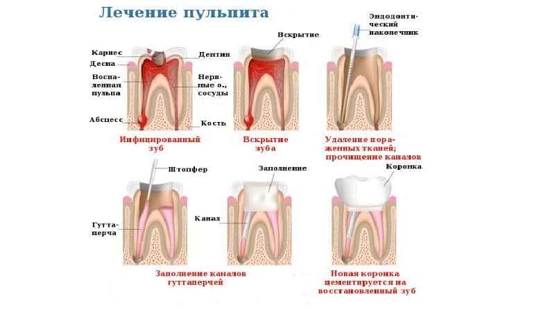 хронический пульпит лечение