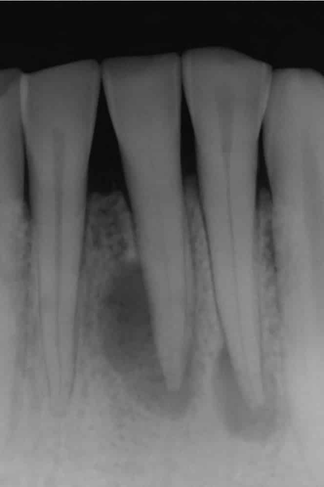 Киста на корне Киста на корне