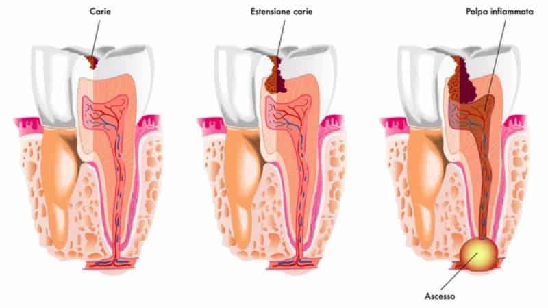 киста на корне зуба лечение народными средствами