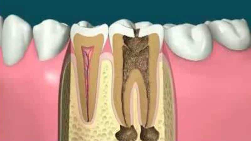 киста на корне зуба лечение антибиотиками