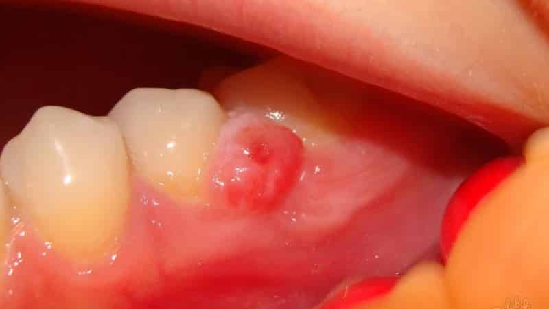 киста верхней челюсти симптомы