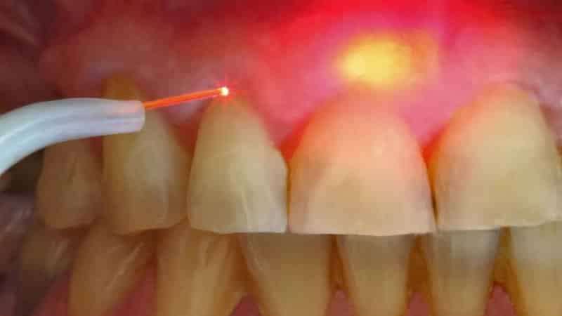 киста зубов верхней челюсти