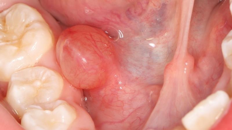 киста под языком фото