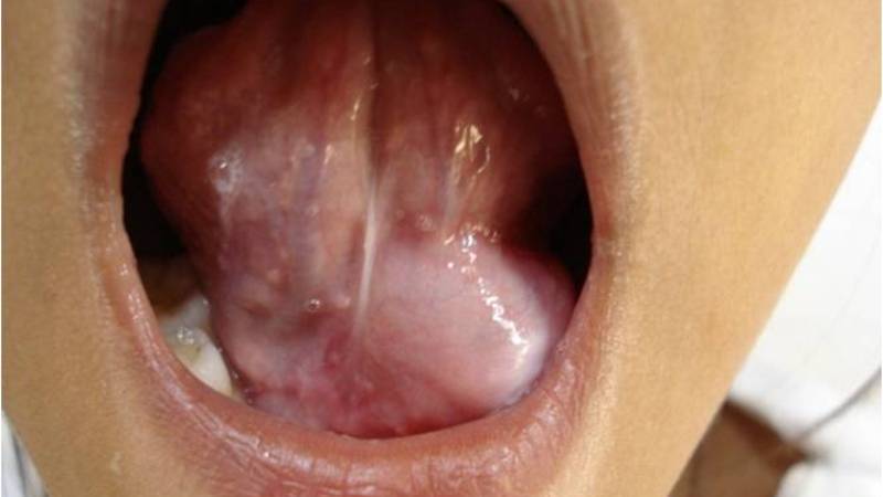 шишки под языком