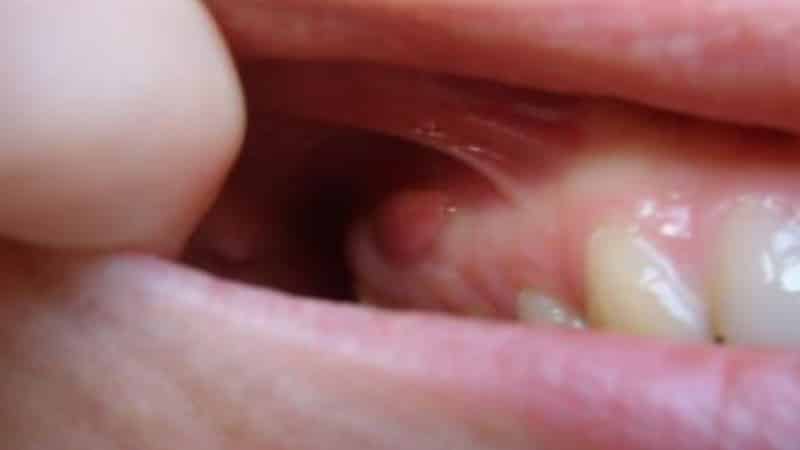 киста в ротовой полости фото