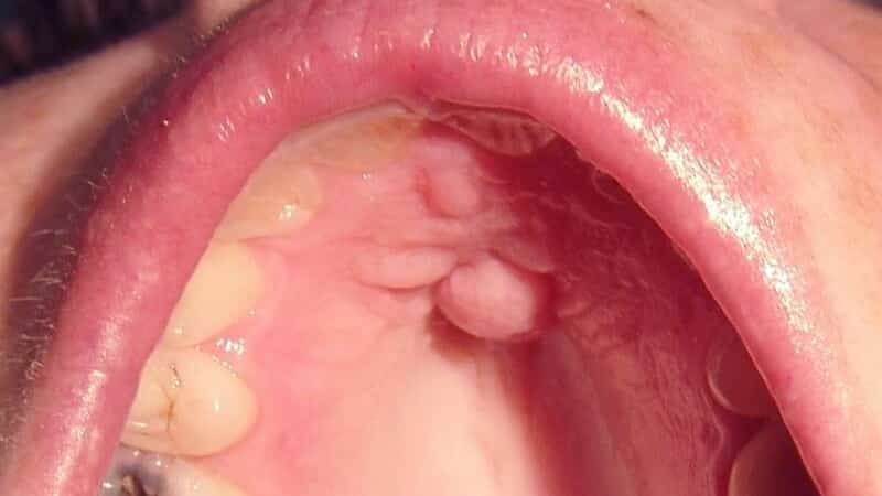 киста на небе во рту фото