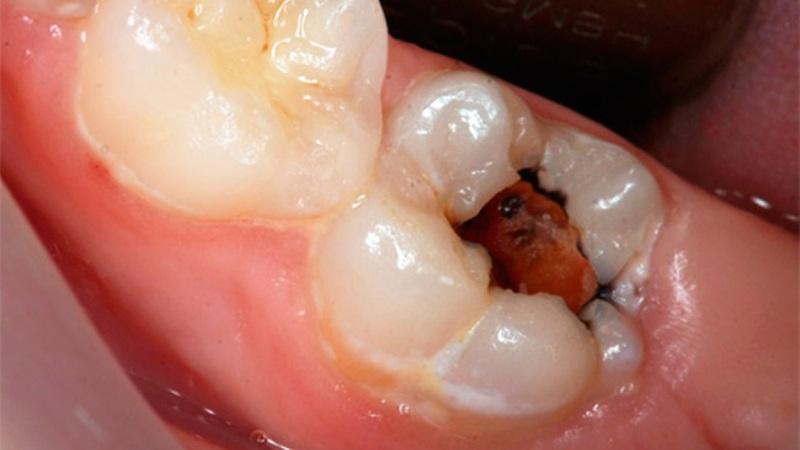 классификация пульпитов