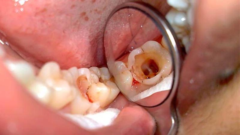 классификация пульпита