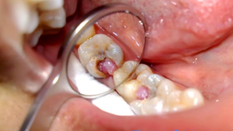 пульпиты классификация