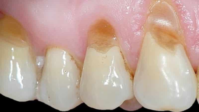 клиновидный дефект зубов фото