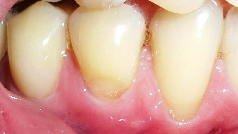 клиновидный дефект зубов лечение