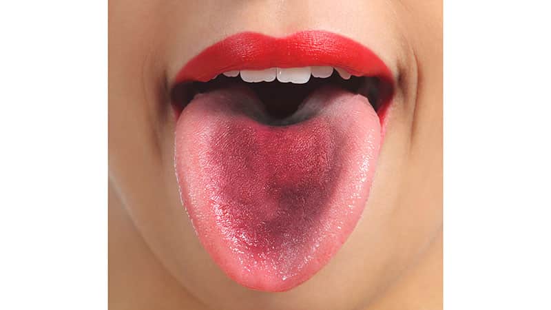 Коричневый налет