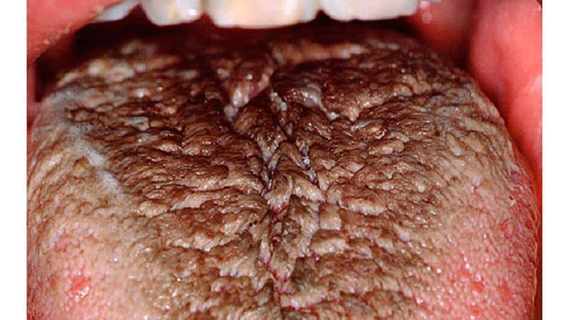 Коричневый налет