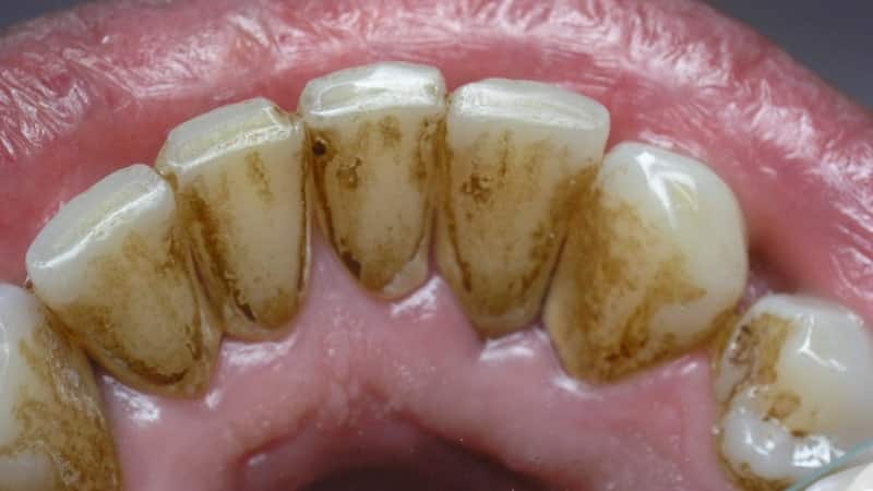 темный налет на зубах причины