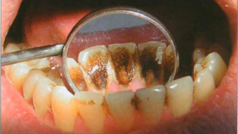 почему на зубах появляется налет