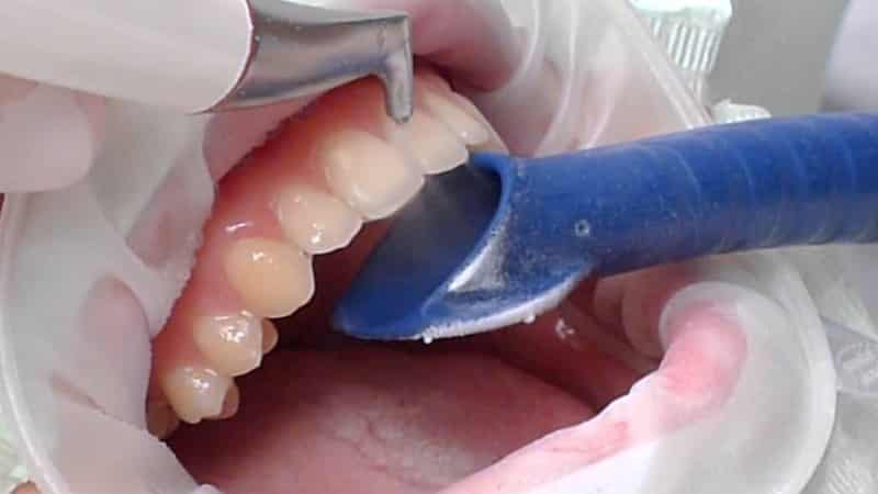 сильный налет на зубах