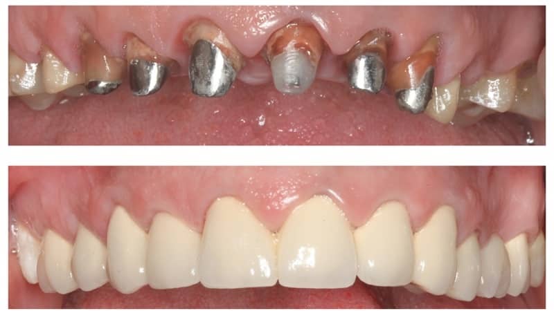 коронки на зубы какие лучше фото