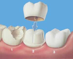 Коронка на зуб Коронка на зуб